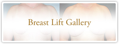 Breast Lift Gallery