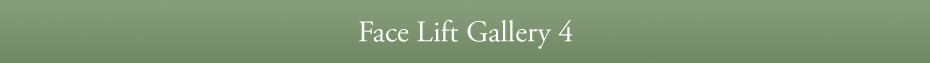 Face Lift Gallery 4