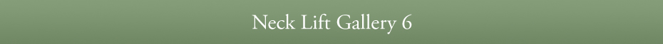 Neck Lift Gallery 6
