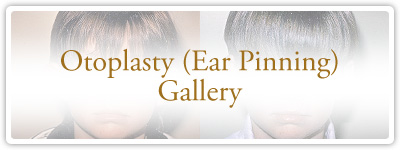 Otoplasty Gallery